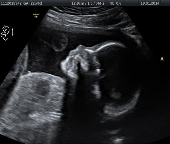 Baby A 22 weeks